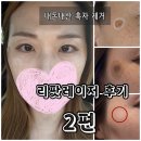 [2편] 내돈내산 흑자 제거 대구 피부과 리팟레이저 후기 비포 애프터 비교사진