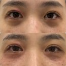 내돈내산 대구에서 콜드플라즈마로 유명한 아미뷰티 잡티 색소침착 제거 후기