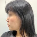 신사 올타이트리프팅 하프해진 이중턱 피부클리닉의원 전후 후기 (통증X, 가격, 다운타임X)