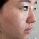 더마웰피부과의원 | [🤍더마웰피부과의원] 골드ptt, 프락셀 후기(일주일간 사진⭕️)