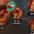 골든치과의원 | [아산 연세원치과]사랑니 발치 왜 25세가 '골든타임'인가?