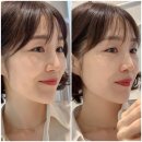 강남역피부과 티타늄리프팅 60KJ로 한번만에 효과본 후기! (+티타늄 가격)