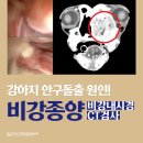 NR-3[경상대로]-상-365 | 강아지 안구돌출로 내원, 비강내시경·CT 이용한 비강종양 진료 ; 부산 비강내시경 동물병원