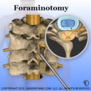 경추신경근증 (Cervical Radiculopathy) 이미지
