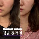레드튠 | 튠레드 튠라이너 가격 대비 만족한 효과 후기와 부작용 주기 총정리