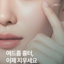 주어드바이저스 | 성인 여드름 흉터 개선 포텐자 시술 압구정 피부과 상담 전 꼭 알아둘 점