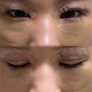 지한약국 | 쌍수(매몰), 눈밑지 수술 당일 후기부터 7일차 기록 눈변화
