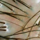 림 스칼프 이미지