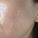 바른침한의원 | 상계동피부과 얼굴 패인 흉터 제거 시술 4회차 한의원 새살침 후기