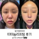 압구정 | 압구정피부과 티타늄리프팅후기