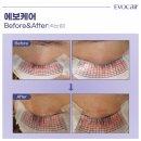 속눈썹 빨리 자라는법?! 있다 없다