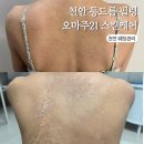 알라딘 스킨케어 | 천안피부관리 오마주21 스킨케어 등드름 알라딘 필링 7일차 후기 후관리 방법