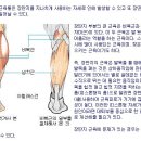 장딴지 근육통의 원인 이미지