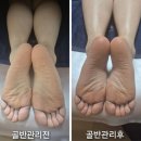 1회 관리만으로 허리둘레 2.7cm가 줄었어요!!