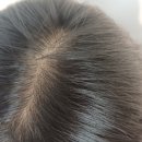 (주)아침정보기술 | 대구두피관리 줄기세포 엑소좀 3회차 후기 대구 SMP studio