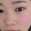 해주사우나 | 청담피부과 솔린의원 리쥬란 효과, 2주 경과 전후비교 솔직 후기