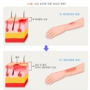 갱신형 신화상치료비보장 특별약관(중증화상및부식진단의 정의 및 진단확정) 이미지