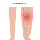 하지 다리 부종 원인 다리가 붓는 이유 및 관리 이미지
