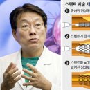 &#34;심장 혈관 &#39;스텐트 시술(혈관에 금속 그물망을 삽입하는 시술)&#39; 꼭 할 필요는 없어요&#34; 이미지