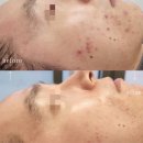 합성동303 | 마산 합성동 사춘기 여드름, 지금 방치하면 평생 흔적이 남습니다