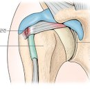 어깨관절 재발성 탈구[recurrent dislocation of shoulder] 이미지