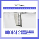 선연합치과의원 | 화성시청치과 임플란트와 뼈이식, 왜 함께 필요한 걸까요?