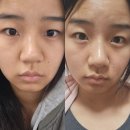 엘스빌딩 | 신사역 피부과 복코 엘스코 솔직후기 (feat.코조각주사)