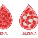 백혈병 초기 백혈구 수치 높으면 체크 이미지