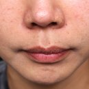 양청초등학교 | 목동피부과 색소치료 후기｜후천성 오타모반 관리 기록 (전후비교)