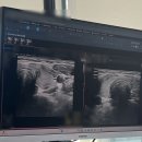 차병원 | 갑상선암 수술 병원 선택의 기로 서울땡큐의원, 분당차병원 후기