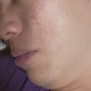 오르다한의원 | 안양새살침 한의원 여드름흉터치료 2회차 후기