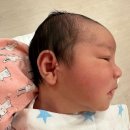 신생아 스킨텍 타이시술 병원 한 달 후기 (귀젖 부이개)