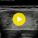 thyroid sono-papillary CA(유두암) 이미지