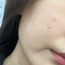 서초대로 302 | 강남역 피부관리 성훈한의원 제네시스토닝 후기