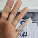 지골 | 손가락 골절 진단 (중위지골) 수술 입원 퇴원 후기