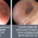 급성 만성 외이도염 원인 진단 예방 이미지