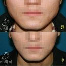보톡스, 내 얼굴 보톡스로 아름답게!