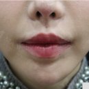 마노성형외과의원 | 입꼬리수술후기 첫수술에 성공하기 위해 따져봐야할 점