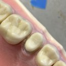 링구얼라인 이미지