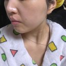 바른온누리약국 | 프락셀 후 예민해진 피부장벽에 바른 EGF재생크림 지피덤