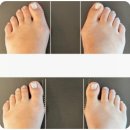 중앙의료기 | 무지외반증 발가락 교정기 후기