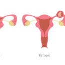 자궁외임신 증상 및 원인과 수술 : 임테기 반응 생리 통증 이미지