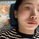 983 | 대구 신세계가정의학과 주근깨/점 제거 비용, 변화 과정