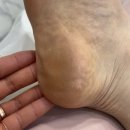 레푸스 구월점 내성발톱 무좀발톱 발각질 문제성발 | [뷰티]레푸스 구월점 내성발톱 무좀발톱 발각질 문제성발