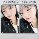 다름성형외과의원 | 강남 성형외과 자가늑 코수술 내돈내산 한달차 후기 5탄 코볼붓기 변화 콧볼흉터연고 추천