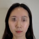 예비신부를 위한 청담동 피부관리 비알부티크 V9 시그니처 리프트 리얼 후기 윤곽부터 광채까지!!
