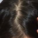 리얼미의원 | 이마는 그대로, M자·가르마만 자연스럽게 채웠습니다 | 디자인 중심 모발이식 후기