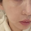 다크서클에는 역시 림피드 압구정성형외과 시술후기 2회차 들고왔어요