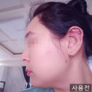 라인피아 | 수술 없이 코라인 홈케어? 쏠피아 코 교정기 괄사마사지기 후기