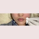 귀족 | 팔자주름 시술 귀족침 후기｜하루 만에 효과 봄